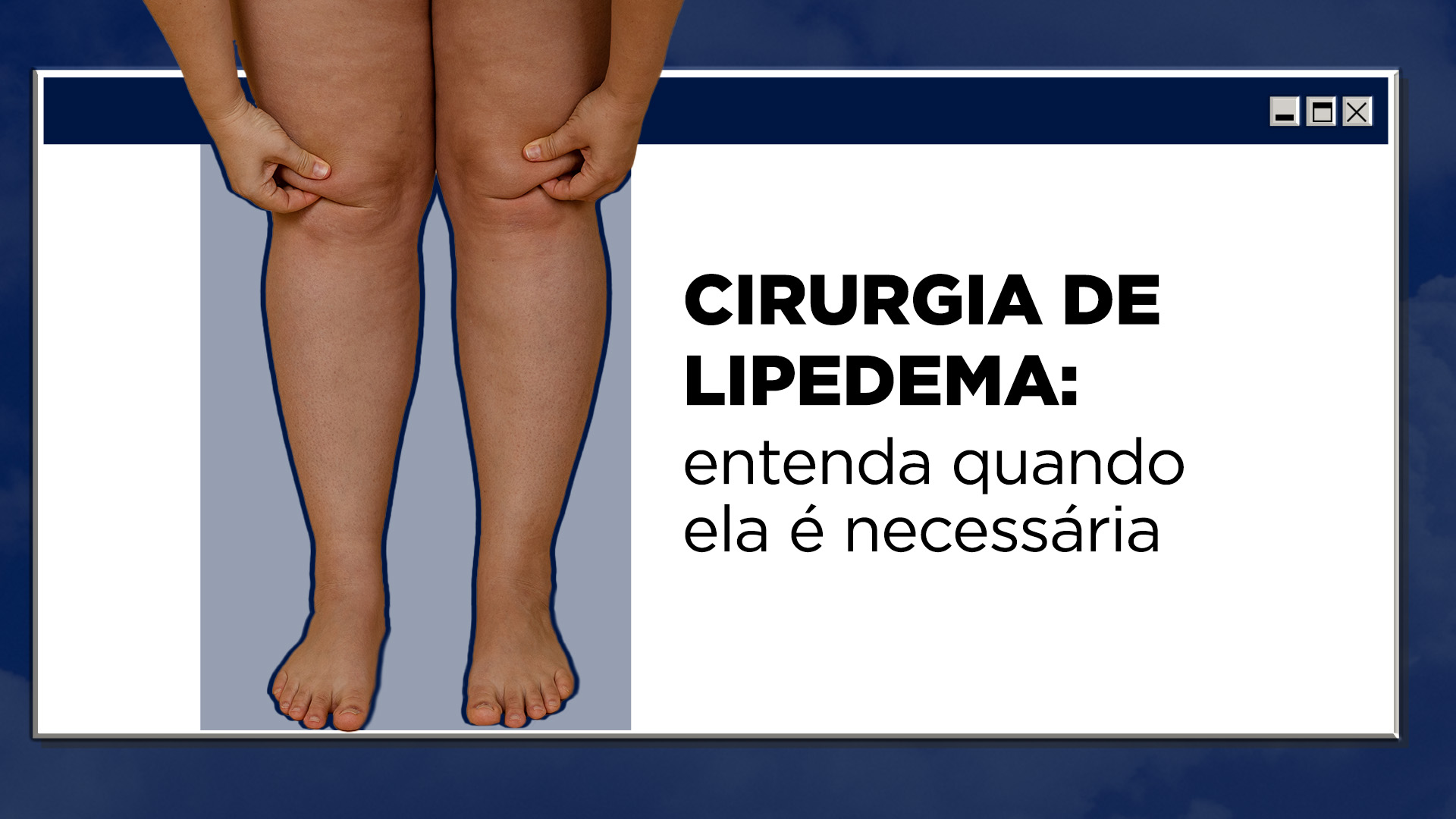 Cirurgia de lipedema: entenda quando ela é necessária - Sidesc